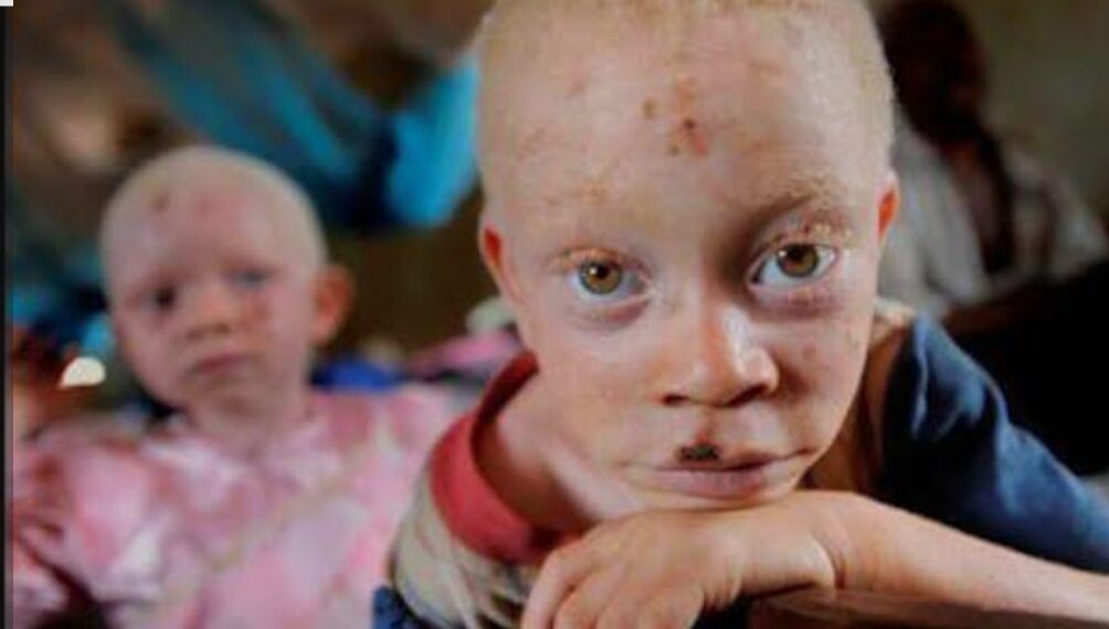 Guinée : Vivre avec l’albinisme, entre vulnérabilité et préjugés