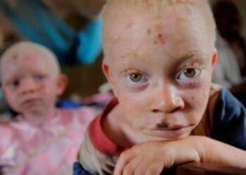 Guinée : Vivre avec l’albinisme, entre vulnérabilité et préjugés