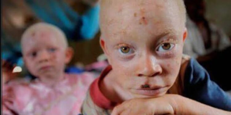 Guinée : Vivre avec l’albinisme, entre vulnérabilité et préjugés